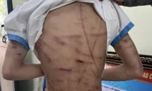 Cha dượng bị khởi tố vì dùng búa đinh bạo hành bé gái lớp 5